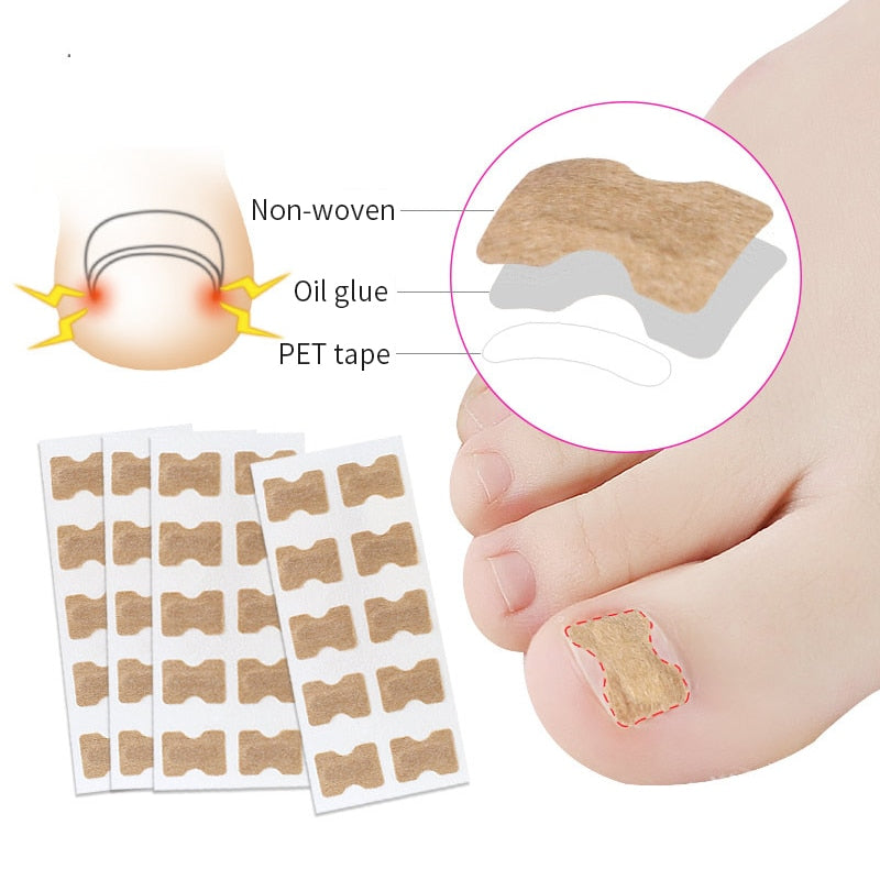 Toe Align Ingrown Nail Corrector Stickers