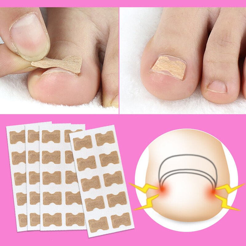 Toe Align Ingrown Nail Corrector Stickers